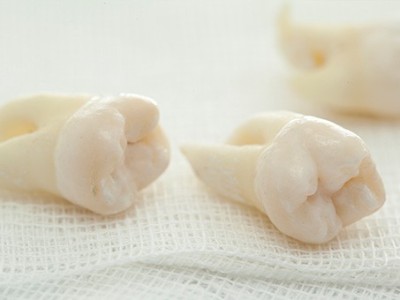 智齒疼了，這牙非拔不可嗎？