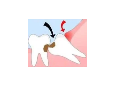 吃完飯后老塞牙？別大意！這可能是你的牙齒在報(bào)警