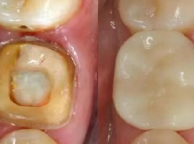 根管治療（抽神經(jīng)）后，為什么一定要做牙冠？