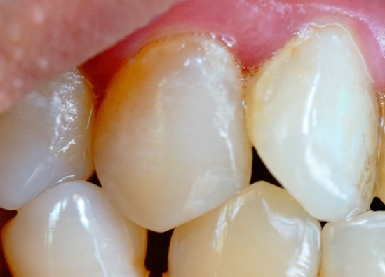 牙齒表面的牙釉質(zhì)掉了還可以修復(fù)嗎？