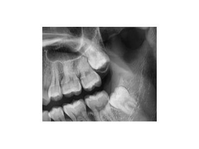 既然「智齒」不宜久留，為什么不能一次性拔掉？