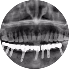 數(shù)字化導(dǎo)板提高種植準(zhǔn)確度