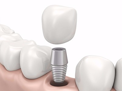 在承德哪家口腔醫(yī)院口腔種植齒好一點(diǎn)，惟德口腔醫(yī)院值得您的選擇