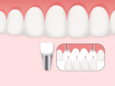 惟德口腔口腔種植怎么樣？惟德口腔就來為您一一解答
