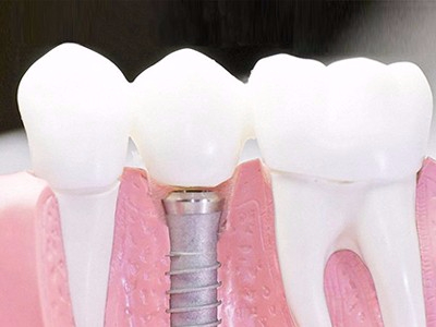 在承德口腔種植齒需要多少錢(qián)？惟德口腔一一為您道來(lái)